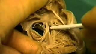 Anatomy of atrioventricular septal defects course 10