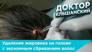 Удаление жировика на голове с экономным сбриванием волос