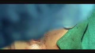 Hymenectomy for Imperforate Hymen