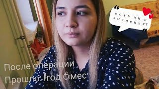 УЗД носовых раковин часть 3. | Результаты через 1,5года | Ответы на вопросы.