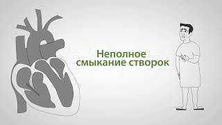 Трикуспидальная недостаточность