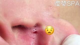 123456—黑頭粉刺？