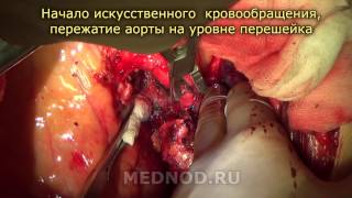 Расширенная пневмонэктомия с резекцией и протезированием  аорты (РНЦХ им.акад. Б.В. Петровского)