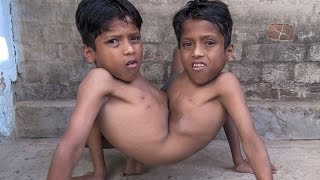 Top 5 People With Extra Body Parts