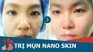 Quy trình trị mụn bằng công nghệ Nano Skin tại Kangnam