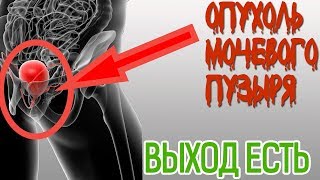 Беспокоит ОПУХОЛЬ МОЧЕВОГО ПУЗЫРЯ? Изучены основные ПРИЧИНЫ возникновения опухоли МОЧЕВОГО ПУЗЫРЯ