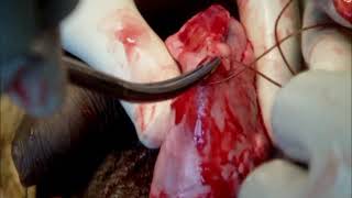 Hydrocele