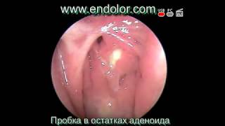 Аденоиды. Казеозные пробки. Postnasal Drip