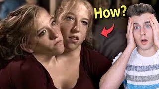 Meet The Two Girls Who Share A Body