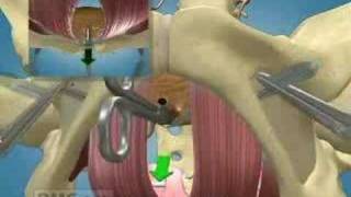 Minimally Invasive Surgery Corrects Urinary Incontinence