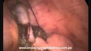 APENDICITIS AGUDA POR PARASITOS (OXIUROS) -  APENDICECTOMIA LAPAROSCOPICA