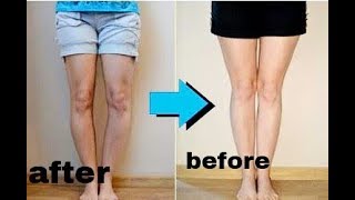 Knock Knee exercise || army medical ghutno me gape ka ilaz..