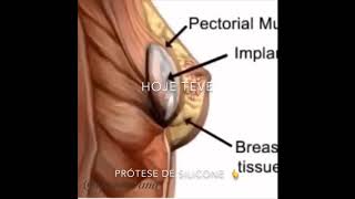 Mamoplastia De Aumento Com Prótese De Silicone Periareolar