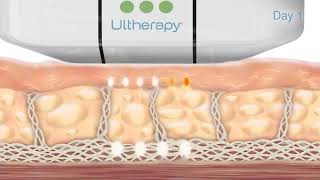Ultherapy Treatment in Dubai, Abu Dhabi & Sharjah - Ulthera Dubai