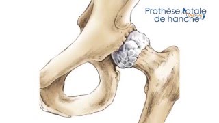 Votre prothèse de hanche à la Clinique Arago - Groupe Almaviva Santé