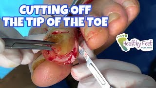 CUTTING OFF THE TIP OF THE TOE (HAMMERTOE), HAMMERTOE CURE, HAMMERTOE SURGERY