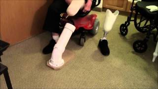 Prosthetic leg attachment assist