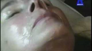 Lifting Facial sin cirugía con Radiofrecuencia