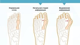 Москва Valgus pro подделка