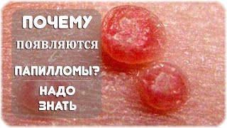 Отчего появляются папилломы?