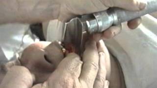 Интубация трахеи (  Intubation of the trachea )