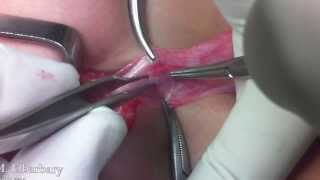 Pediatric Uro-surgery done by Dr. Mohamed Elbarbary Part I