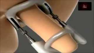 ProExtender - Popular Penis Enlargement, Sex Toy