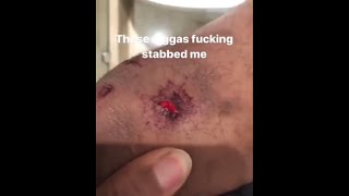 xxxtentacion Stabbed By Migos And Blood In His Hair Lmao