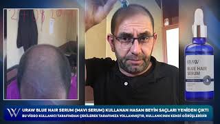 Uraw Blue Hair Serumu ( Mavi Serum ) kullandı saçları yeniden çıktı
