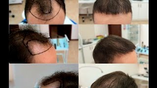 Результат До и После пересадки