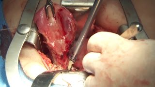 Total Abdominal Hysterectomy Surgery - THUNDERBEAT - Olympus Surgical - Dr. Francois Blaudeau