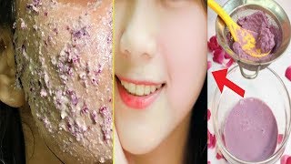 ৯মিনিটে গোলাপ দিয়ে সহজেই ঘরে বসে ফেসিয়াল করে ত্বককে ফর্সা ও গোলাপি আভা ফুটিয়ে তোলার সহজ উপায়-rose