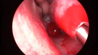 Шейверная подслизистая редукция нижних раковин (microdebrider-assisted turbinoplasty)
