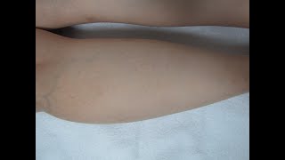 90스테로이드 약물의 부작용 튼살 치료 자향미한의원 st침 쿠싱증후군 문페이스