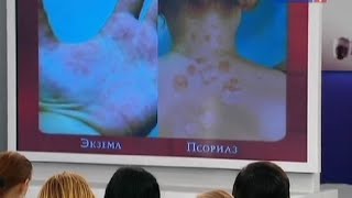 Экзема: симптомы, причины и лечение. Стадии и варианты лечения экземы