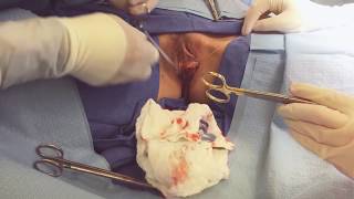 Labiaplasty - Live Surgery by Dr. Phillip Chang in Virginia www.GoToBeauty.com