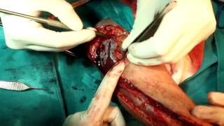 Female to Male Sex Change Surgery in India (Phalloplasty)