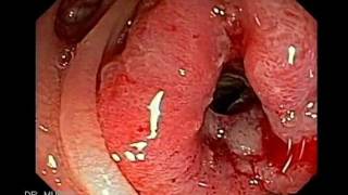 Colonoscopia: Caso de Cancer del Colon Descendente