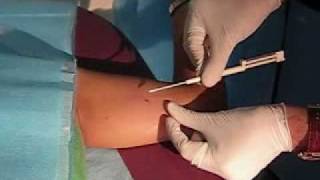 técnica de insercion del implante subdérmico anticonceptivo implanon insertion