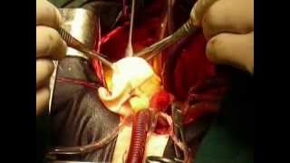 Процедура Росса с использованием кондуита Пилон. Ross procedure with Pilon conduit