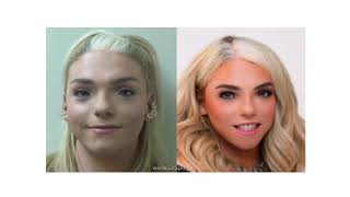 Facial Feminization Surgery