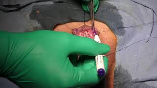 Redo hypospadias surgery: current and novel techniques – Video abstract [ID 142989]