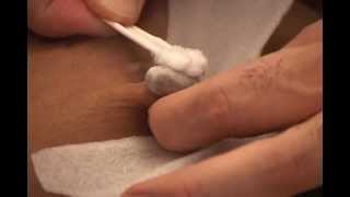 Navel Keloid - Belly Button keloid - Removal with Cryotherapy