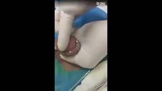 circumcision of a penis