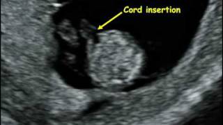 Fetal Medicine Foundation - Fetal anatomy 12 weeks