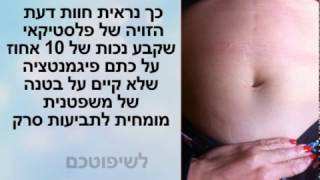 ניתוח אף פיצוי | ניתוחי אף פיצוי | ניתוח אף לא יפה | ניתוח אף לא מוצלח | פיצוי ללא משפט