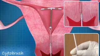 Intra Uterine Device (IUD) Copper T Animation | ADMAA