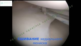 АРТРОСКОПИЧЕСКИЙ ШОВ МЕНИСКА - ПО ПОВОДУ РАЗРЫВА МЕДИАЛЬНОГО МЕНИСКА