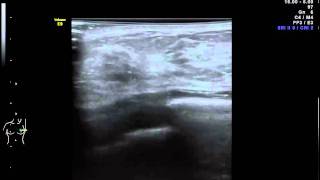 Mastopatia fibroquistica   centro diagnostico de mamas  Dr. Rafael  Ortega Muñoz Ciudad Real