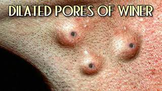 Best DPOWs, Zits, Acne & Whiteheads, Popping = Blackhead Masks